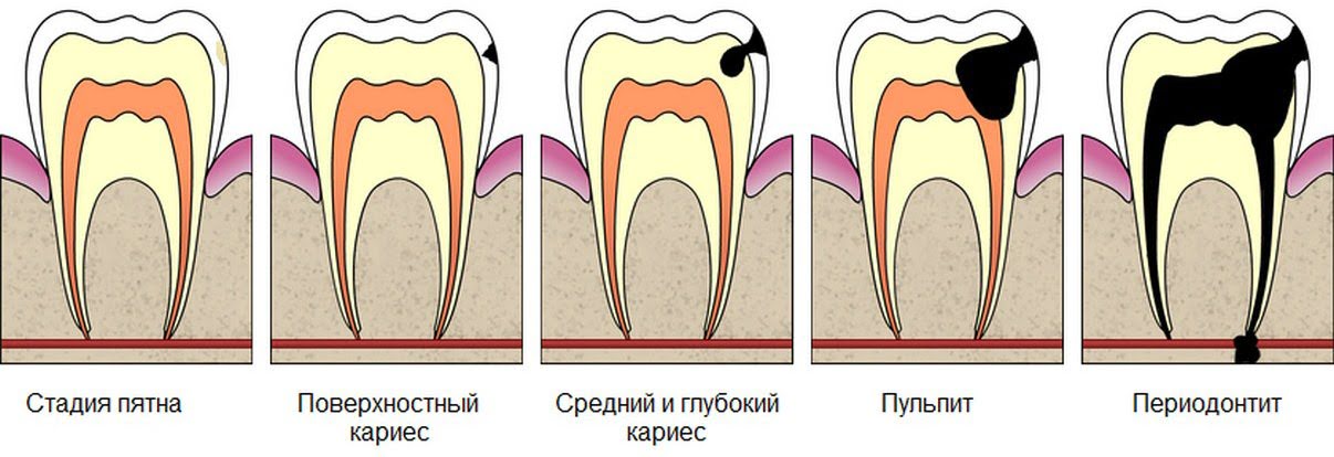 Стадии развития кариеса