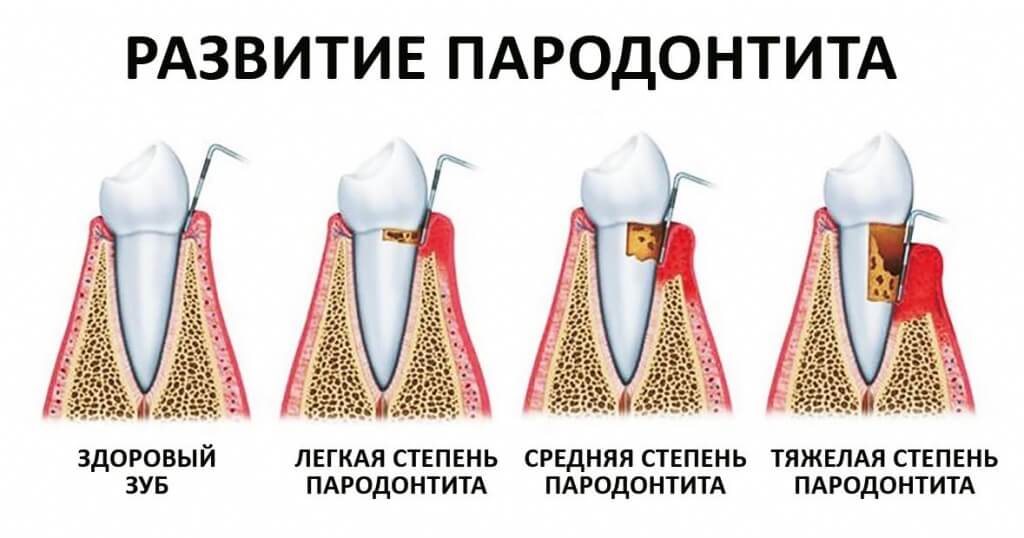 Стадии развития пародонтита