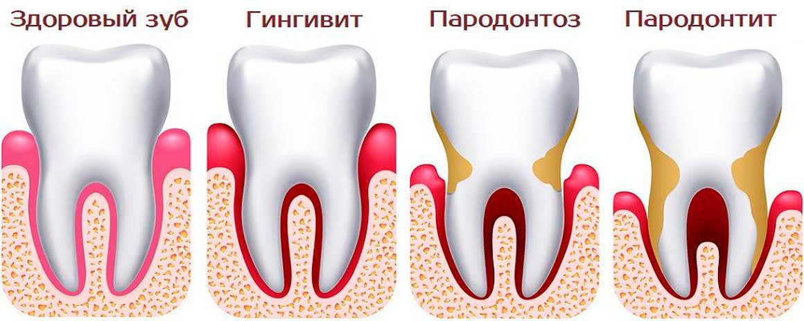 Стадии развития пародонтоза