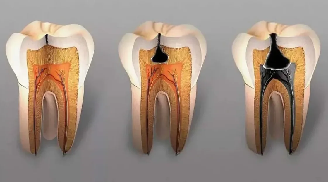 Стадии развития пульпита